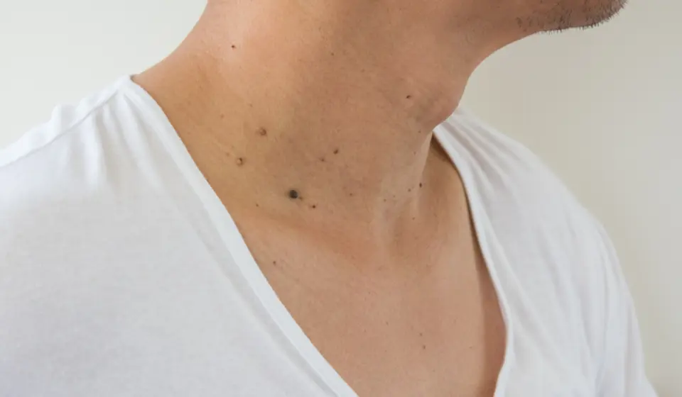 mole-wart-check.png